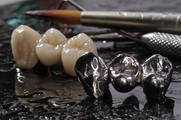 E-max pressed ceramic bridge and metal crown with dentistry utensils