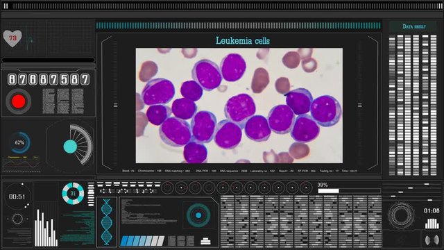 leukemia cells with medicine hologram in laboratory. Science background. futuristic technology. 