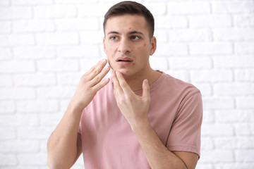 Portrait of young man with acne problem against white brick wall