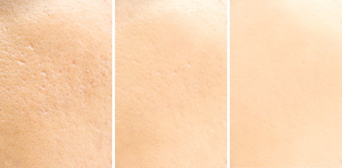Compare before and after (retouch photo) of close up wide large pores skin on oily face have pimple...