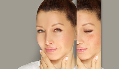 Post-Acne Marks /Treating Acne Scars