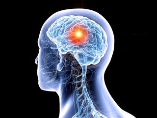 3d rendered medically accurate illustration of the human brain and a tumor