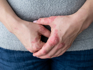 Cracked, flaky skin on the palm of your hand. Dermatological problems of psoriasis. Hard, horny and cracked skin on the finger in a man's hand. Psoriasis, allergy