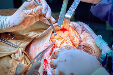 Facial plastic surgery operation. Face lift surgery. Surgeon separated the skin from the patient's...