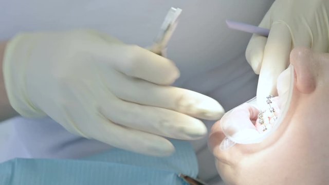 Close-up of dentist's hand in rubber gloves sets adult braces to an adult woman. Prevention braces in adulthood. Dentistry in 4k