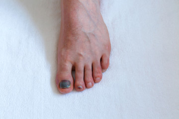 Human male left foot on white background with bruised black on toe nail