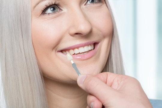 Using a shade guide at womans mouth to check veneer of tooth crown