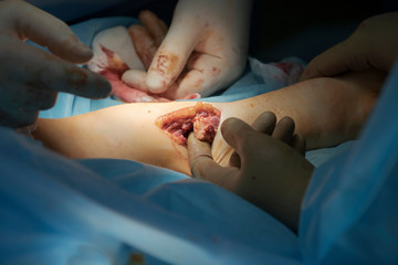 Ulna Bone Section During Surgery