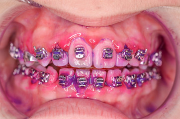 lack of oral hygiene under orthodontic treatment