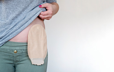 Front view on colostomy pouch in skin color attached to woman patient. Close-up on ostomy bag after...
