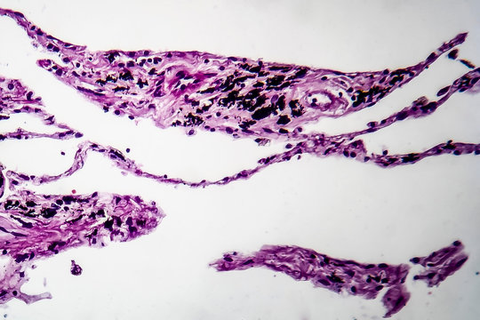 Histopathology of lung emphysema, light micrograph, photo under microscope showing enlargement of air spaces in lung tissue and destruction of alveolar septa