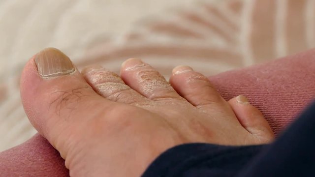 foot health, fungal disease in the toes, close-up human foot,