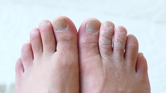foot health, fungal disease in the toes, close-up human foot,