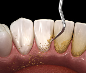 Oral hygiene: Ultrasonic teeth cleaning machine removing calculus and plaque. Medically accurate 3D...