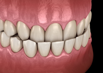 Underbite dental occlusion ( Malocclusion of teeth ). Medically accurate tooth 3D illustration