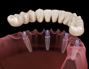 Mandibular prosthesis All on 4 system supported by implants. Medically accurate 3D illustration of human teeth and dentures concept