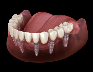 Mandibular prosthesis All on 6 system supported by implants. Medically accurate 3D illustration of human teeth and dentures concept