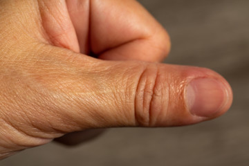 Woman's scar skin on thumb of hand, Close up & Macro shot, Asian Body skin part, Healthcare concept, Abstract background