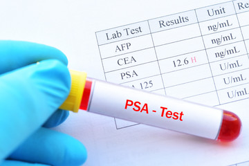 Abnormal high PSA test result with blood sample tube