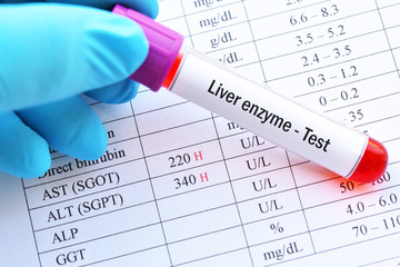 Abnormal high liver enzyme test result with blood sample tube