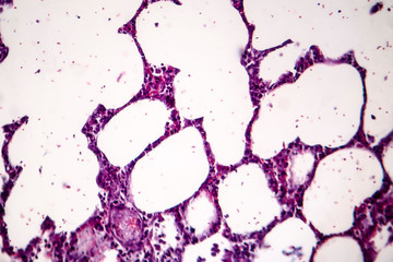 Histopathology of pneumonia, light micrograph, photo under microscope. Cellulose aspiration...