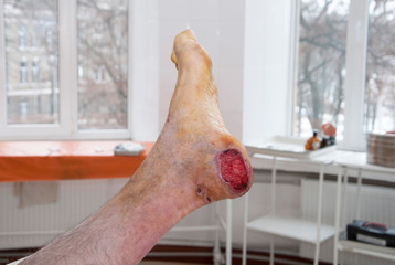 Foot wound becomes infected. Patients with diabetes, foot ulcers