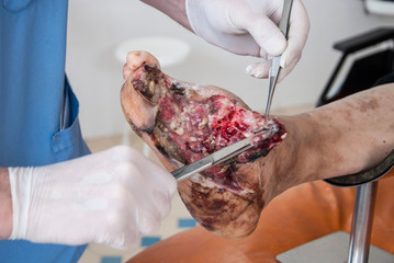 Foot wound becomes infected. Phlegmon of the foot. Purulent wound of the foot. Foot surgery....