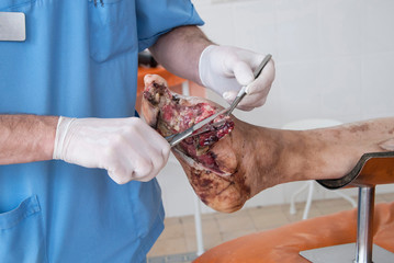 Foot wound becomes infected. Phlegmon of the foot. Purulent wound of the foot. Foot surgery....