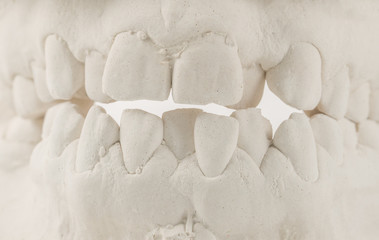 Dental casting gypsum model of human jaws. Crooked teeth and distal bite. Shots were made before treatment with braces . Technical shots on gray background - obrazy, fototapety, plakaty