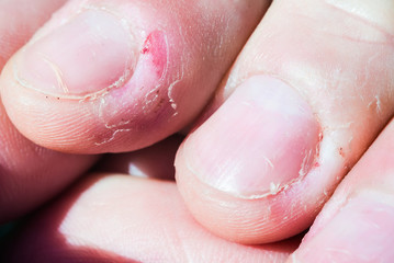 Bitten skin on the fingers
