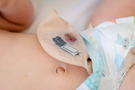 Close-up top view on transparent colostomy pouch attached to baby patient. Ostomy bag with filter hidden in baby diaper.
