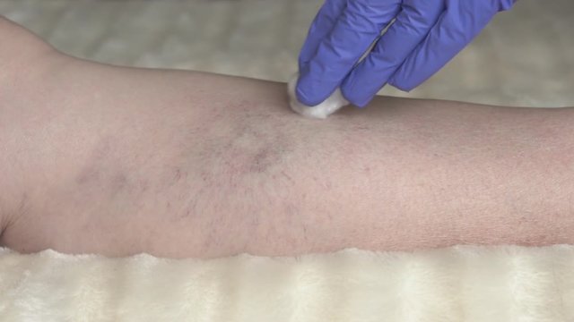 Doctor performs sclerotherapy for varicose veins on the legs, varicose vein treatment, injection, slow motion