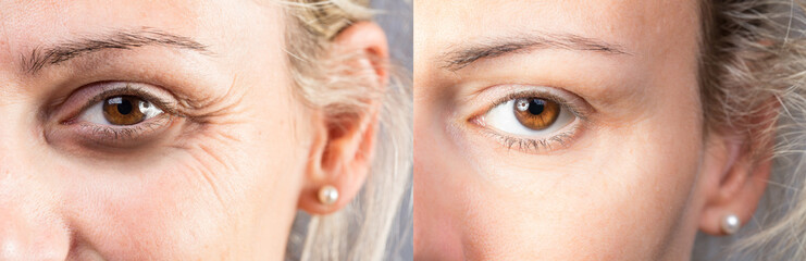 Wrinkled eye with dark circles before and after lifting and correction