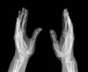 X-ray picture - Human palms