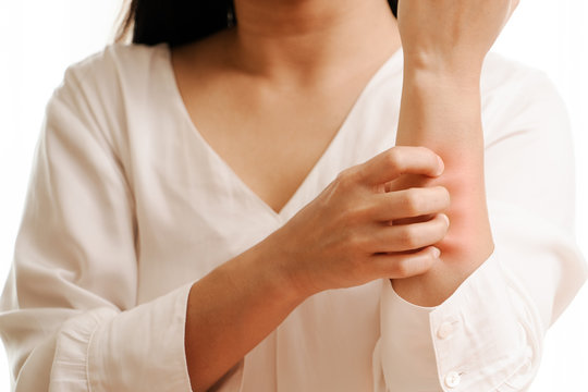Women hand scratch the itch on arm, healthcare and medicine concept