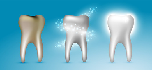 Beautiful realistic dentist vector set of teeth cleansing process with decayed, cleansed and white shiny teeth on blue background.