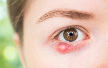 Fototapeta premium Eyelid abscess. Close up photo of young caucasian woman barley brown eye infection, eyelid abscess, stye, hordeolum. Concept of health, disease and treatment.
