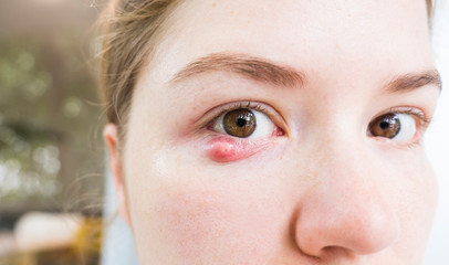 Eyelid abscess. Close up photo of young caucasian woman barley brown eye infection, eyelid abscess, stye, hordeolum. Concept of health, disease and treatment.