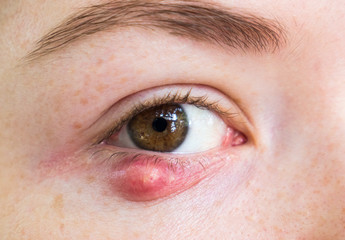 Fototapeta premium Eyelid abscess. Close up photo of young caucasian woman barley brown eye infection, eyelid abscess, stye, hordeolum. Concept of health, disease and treatment.