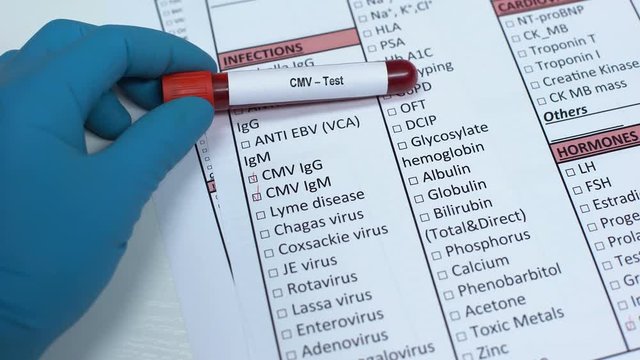 CMV, doctor checking virus in lab blank, showing blood sample in tube