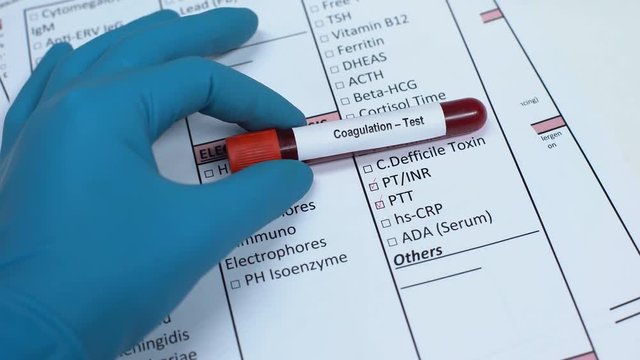 Coagulation, doctor checking name in lab blank, showing blood sample in tube