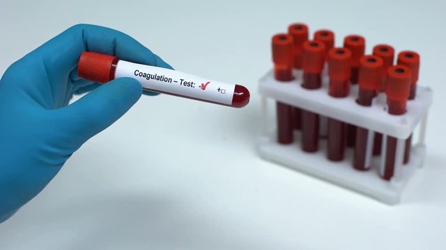 Negative coagulation test, doctor showing blood sample, lab research, healthcare