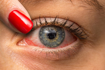 Red eye suffering from allergy - obrazy, fototapety, plakaty