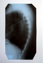 X-ray of the spine and cervical spine