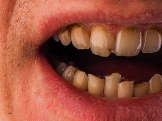 Fototapeta premium Dental medicine and healthcare - human patient open mouth showing caries teeth decay. Unhealthy denture, tartar on frontal teeth, plaque and gingivitis.
