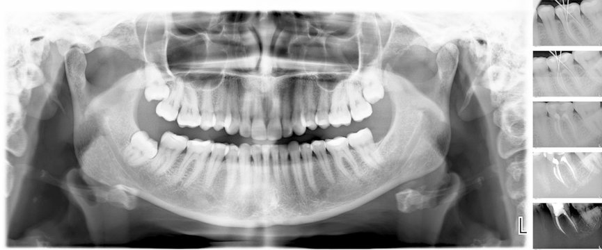 X-Ray scan of human teeth for analyzing and treating with stages of opening and filling of the root canals