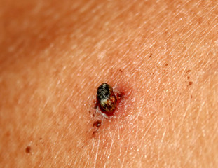 Papiloma birthmark on the skin. Treatment papilomy acid.