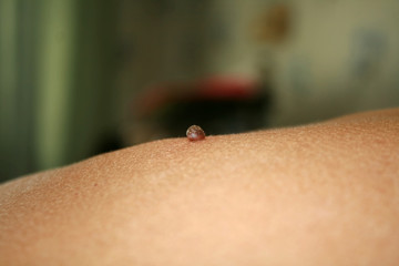 Birthmark on the skin