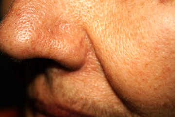 Nasolabial wrinkled fold on the skin of the face.