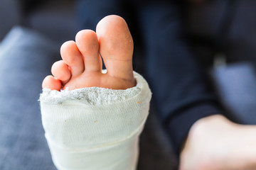 Broken leg in a cast during treatment